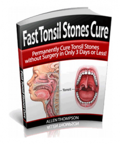 How to Cure Tonsil Stones