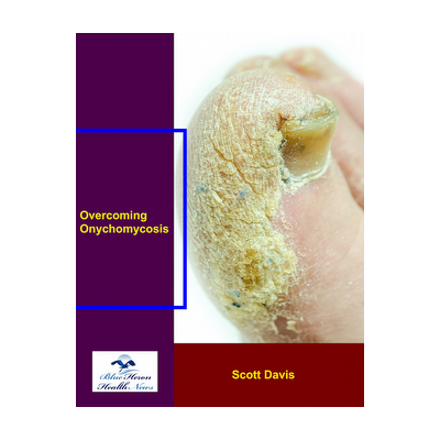 Overcoming Onychomycosis